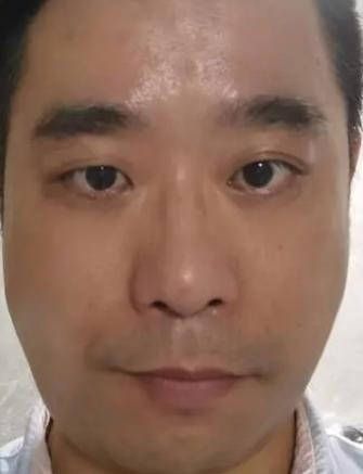 去眼袋手术