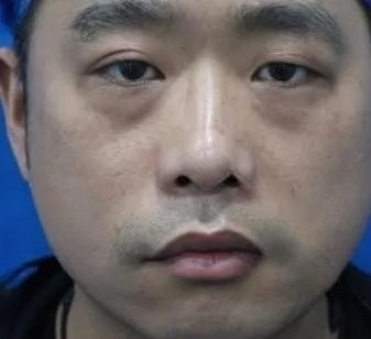 去眼袋手术