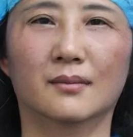 去眼袋手术