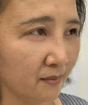 去眼袋手术