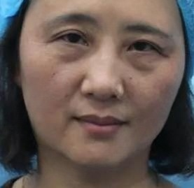 去眼袋手术