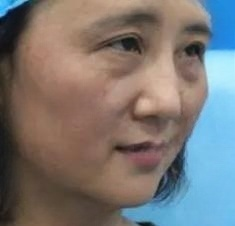去眼袋手术