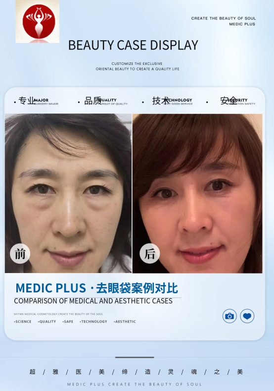 去眼袋手术