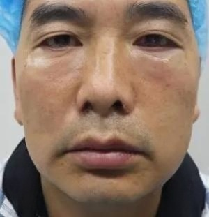 去眼袋手术