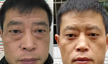 去眼袋手术