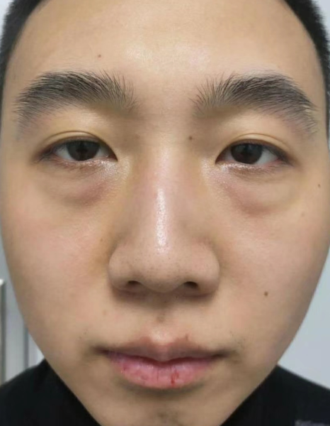 去眼袋手术