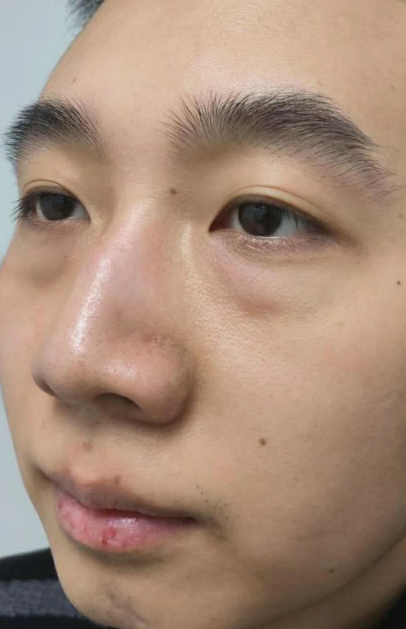 去眼袋手术