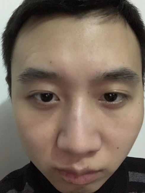 去眼袋手术