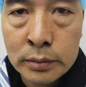 去眼袋手术