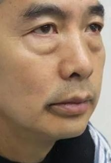 去眼袋手术