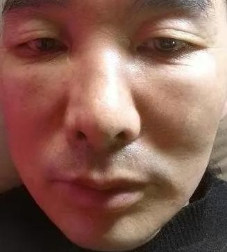 去眼袋手术