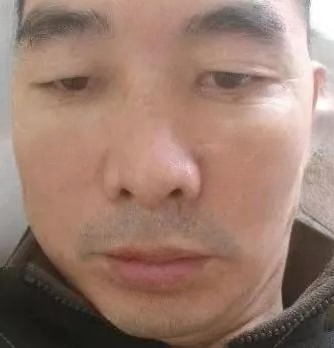 去眼袋手术