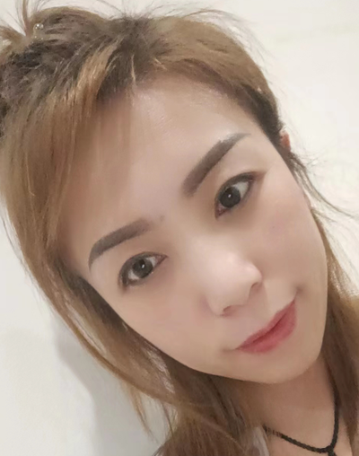 去眼袋手术