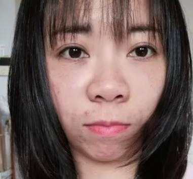 去眼袋手术
