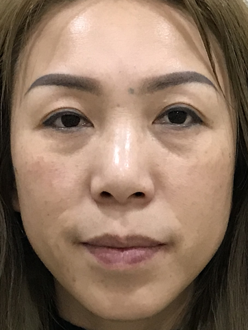 去眼袋手术