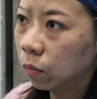 去眼袋手术