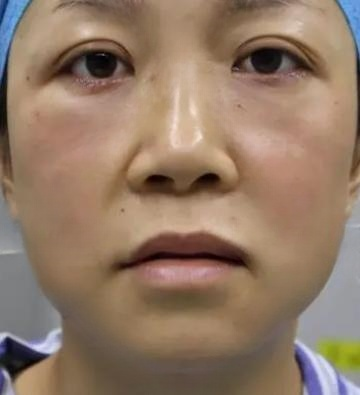 去眼袋手术