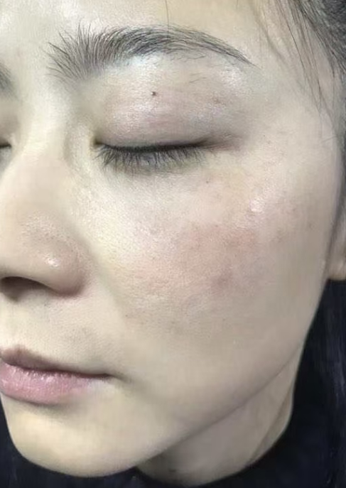 去眼袋手术