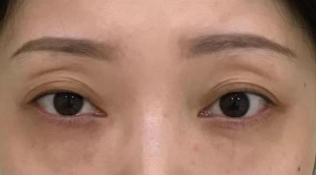 去眼袋手术
