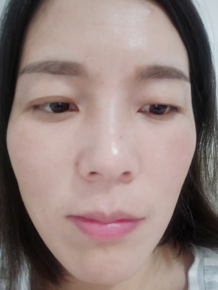 去眼袋手术
