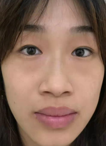 去眼袋手术
