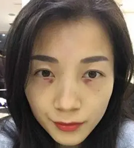 去眼袋手术