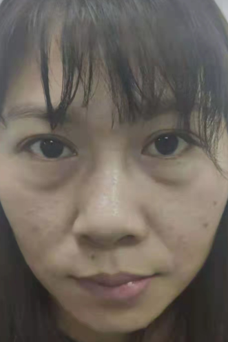 去眼袋手术