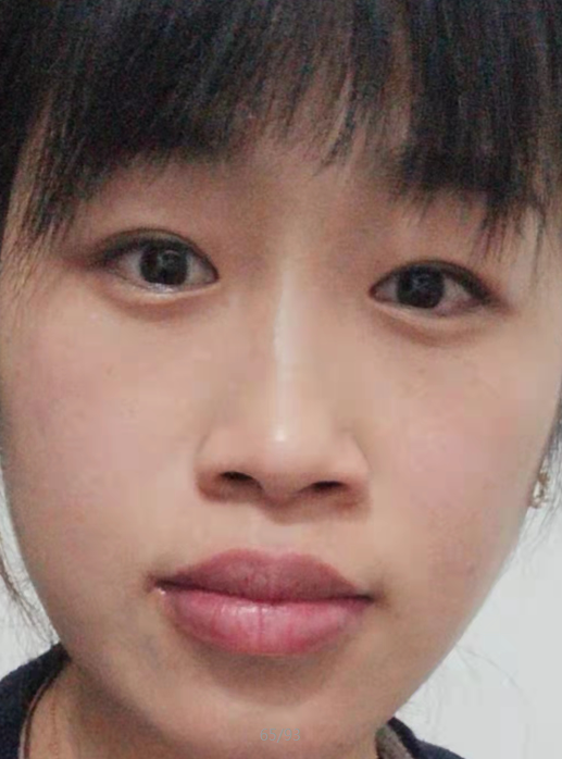 去眼袋手术