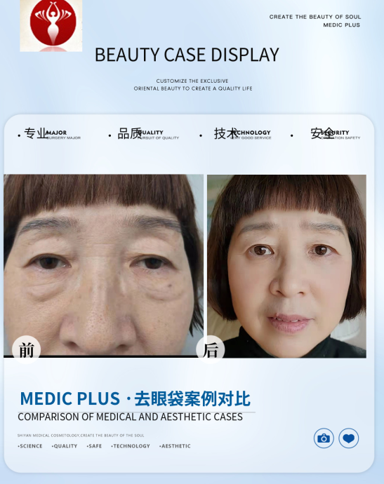 去眼袋手术
