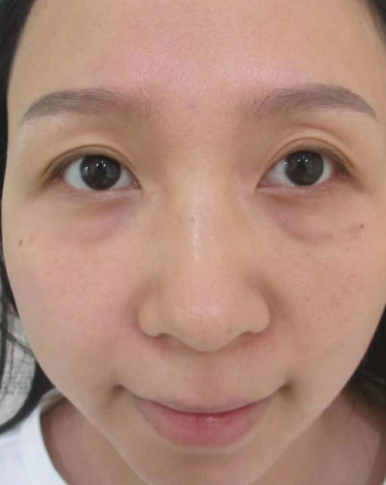 去眼袋手术
