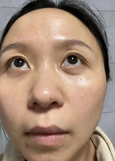 去眼袋手术