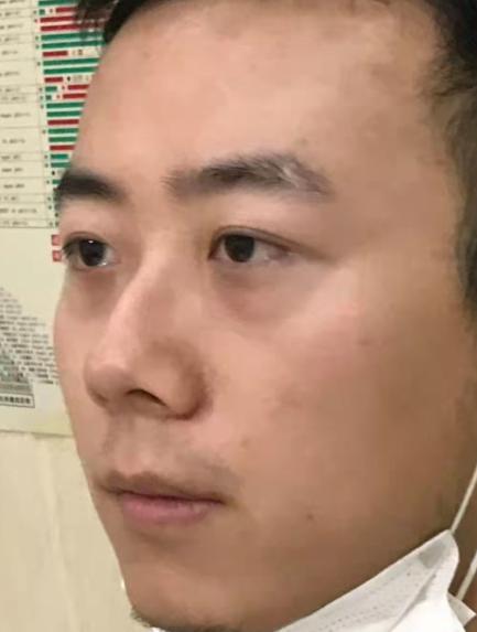 去眼袋手术