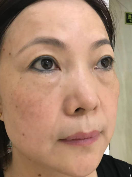 去眼袋手术