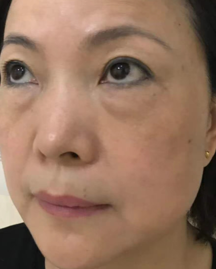 去眼袋手术