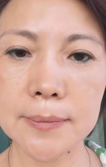 去眼袋手术