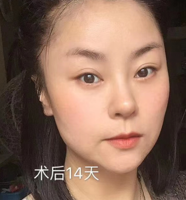 去眼袋手术