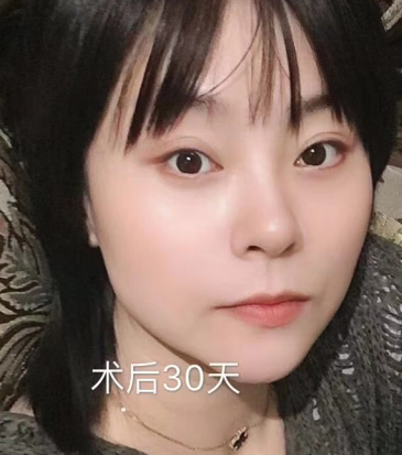 去眼袋手术