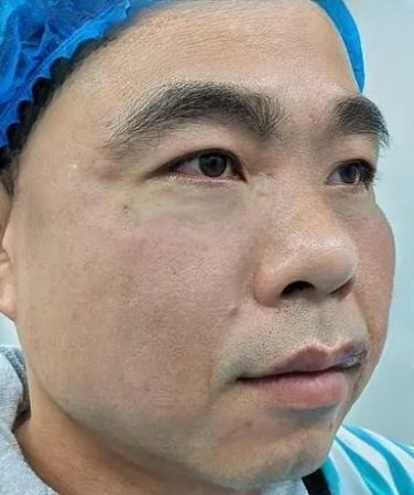 去眼袋手术