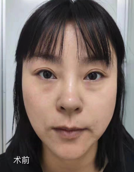 去眼袋手术