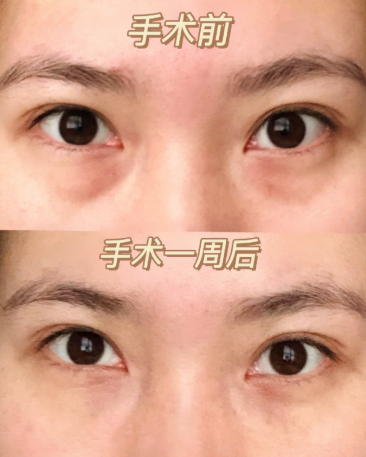 去眼袋手术