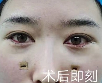 去眼袋手术