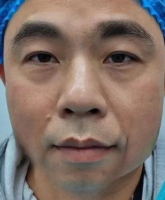 去眼袋手术