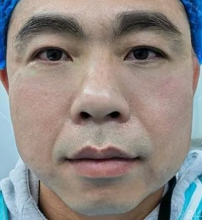 去眼袋手术
