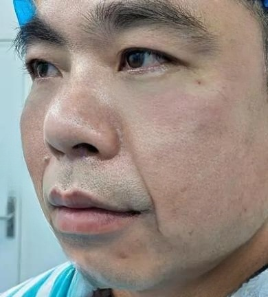 去眼袋手术