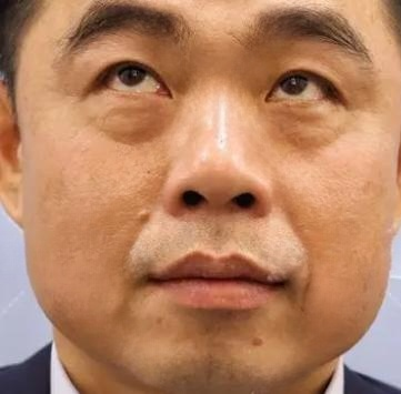 去眼袋手术