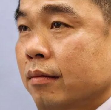 去眼袋手术