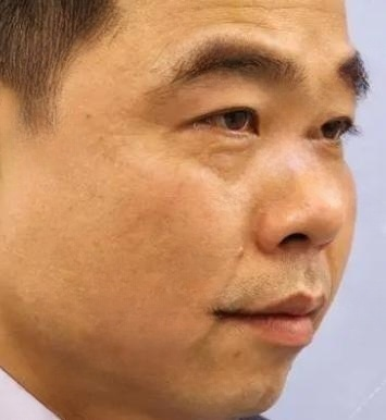 去眼袋手术