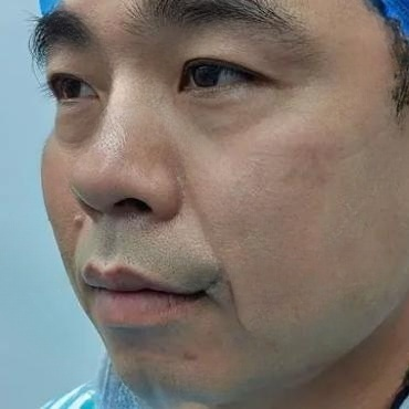 去眼袋手术