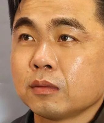 去眼袋手术
