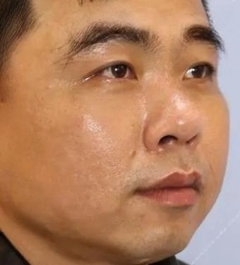 去眼袋手术